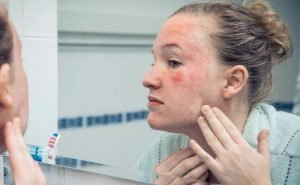 The area around my nose was red and blotchy and later became a blister. What exactly is the problem?