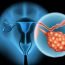 The doctor has asked me to get hysterectomy done. Do I really have to get it done?