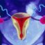The surgeon would be doing Manchester repair for my prolapsed womb. What exactly is it?
