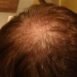 There is a bald patch on my fead. Why is it so?