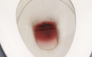 There is slight bleeding, when I pass my stool. Do I need to worry about it?