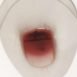 There is slight bleeding, when I pass my stool. Do I need to worry about it?