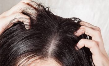 Top 5 remedies for eradication of dandruff