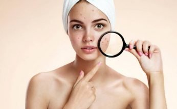 Top 6 Remedies to Cure Acne using Unani Medication