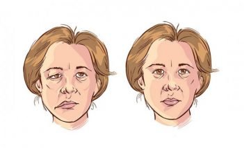 Top Homeopathic medicines for Bell’s palsy
