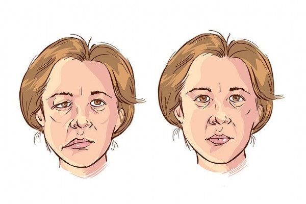 Top Homeopathic Medicines for Bell’s Palsy