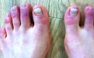 What are chilblains ad how can we prevent it?