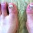 What are chilblains ad how can we prevent it?