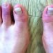What are chilblains ad how can we prevent it?
