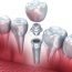 What are crowns made up of ?