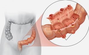 What are the symptoms and treatment of diverticulitis?