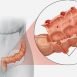 What are the symptoms and treatment of diverticulitis?