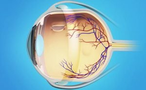 What are the symptoms of detached retina?