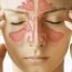 What are the symptoms of sinusitis ?