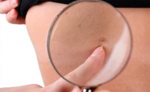 What are the symptoms of skin cancer?