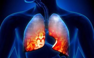 What care should be taken if one is suffering from emphysema?