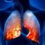 What care should be taken if one is suffering from emphysema?