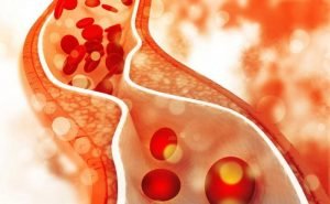 What do you mean by the term 'High blood cholesterol?