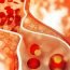 What do you mean by the term 'High blood cholesterol?