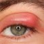 What is a stye?