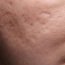 What is acne?