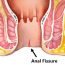 What is anal fissure?