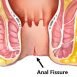 What is anal fissure?