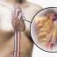 What is angioplasty?