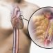 What is angioplasty?