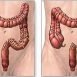 What is colostomy and ileostomy?