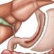 What is gastrectomy?