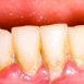 What is gingivitis?