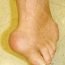 What is gout and is it hereditary?