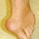 What is gout and is it hereditary?