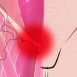 What is hernia?