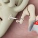 What is otosclerosis?