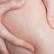 What is phlebitis and what is the treatment?