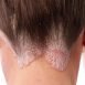 What is psoriasis?
