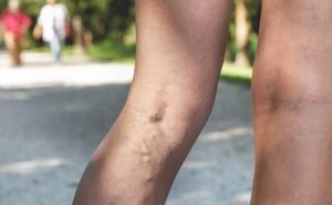 What is the cause for varicose veins?