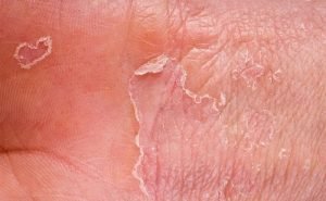 What is the difference between eczema and dermatitis?