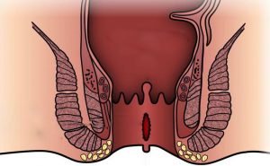 What is the treatment of anal fissure?