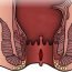 What is the treatment of anal fissure?