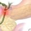What is the treatment of gallstones?