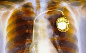 What is the use for pacemaker and hoe does it work?