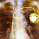 What is the use for pacemaker and hoe does it work?