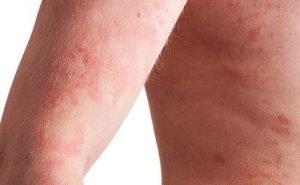 What should be done to get some relief from psoriasis?
