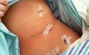 What would happen if I donate one of my kidneys?