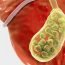Who all may suffer from gallstones?