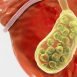 Who all may suffer from gallstones?