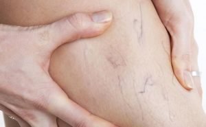 Why are pregnant women more prone to varicose veins?